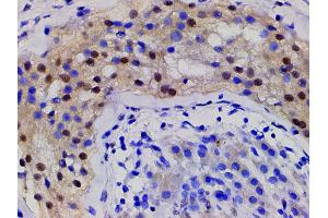 ABIN6267443 at 1/200 staining human seminoma tissue sections by IHC-P.