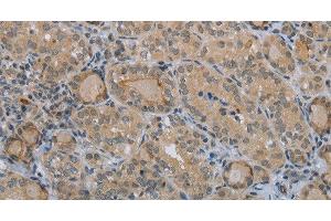 Immunohistochemistry of paraffin-embedded Human thyroid cancer tissue using CLEC1A Polyclonal Antibody at dilution 1:40 (CLEC1A anticorps)