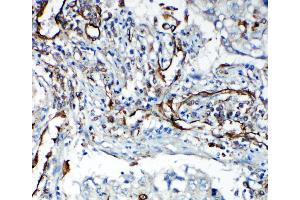 Anti-VEGF Receptor 2 antibody, IHC(P) IHC(P): Human Lung Cancer Tissue