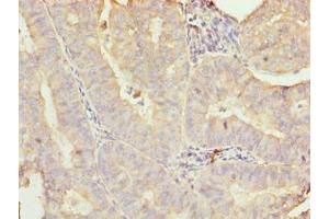 Immunohistochemistry of paraffin-embedded human endometrial cancer using ABIN7160680 at dilution of 1:100 (GALNT7 anticorps  (AA 201-500))