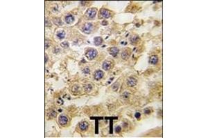 Formalin-fixed and paraffin-embedded human testis tissue reacted with NANOS2 antibody (C-term) (ABIN389197 and ABIN2839360) , which was peroxidase-conjugated to the secondary antibody, followed by DAB staining.