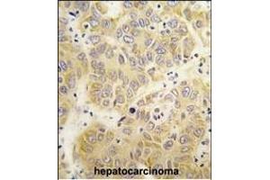 Formalin-fixed and paraffin-embedded human hepatocarcinoma tissue reacted with the VARS antibody (N-term)  , which was peroxidase-conjugated to the secondary antibody, followed by DAB staining. (VARS anticorps  (N-Term))