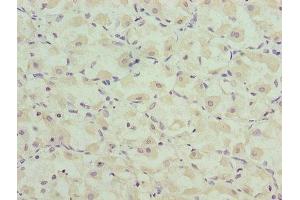 Immunohistochemistry of paraffin-embedded human gastric cancer using ABIN7146581 at dilution of 1:100 (Calsequestrin anticorps  (AA 127-396))