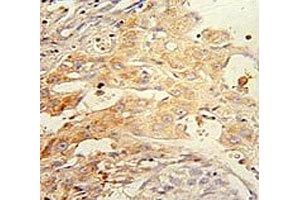 PINK1 antibody immunohistochemistry analysis in formalin fixed and paraffin embedded human hepatocarcinoma.