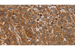 Immunohistochemistry of paraffin-embedded Human lung cancer using PLEKHG6 Polyclonal Antibody at dilution of 1:45 (PLEKHG6 anticorps)
