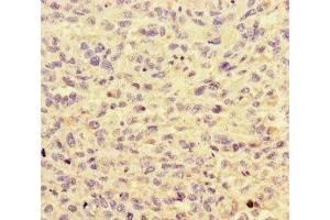 Immunohistochemistry of paraffin-embedded human melanoma using ABIN7155108 at dilution of 1:100 (HNRNPF anticorps  (AA 186-336))
