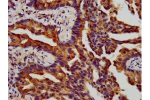 IHC image of ABIN7156494 diluted at 1:400 and staining in paraffin-embedded human lung cancer performed on a Leica BondTM system.