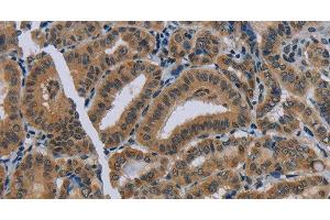 Immunohistochemistry of paraffin-embedded Human thyroid cancer using NAT10 Polyclonal Antibody at dilution of 1:40 (NAT10 anticorps)