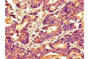 Immunohistochemistry of paraffin-embedded human colon cancer using ABIN7155305 at dilution of 1:100 (HDAC1 anticorps  (AA 207-412))
