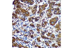 Immunohistochemistry of paraffin-embedded Human liver cancer using CTNN Rabbit pAb (ABIN7266136) at dilution of 1:100 (40x lens). (CTNNA3 anticorps  (AA 1-240))