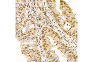 Immunohistochemistry of paraffin-embedded human colon carcinoma using SS18 Rabbit pAb (ABIN6133185, ABIN6148473, ABIN6148474 and ABIN6222754) at dilution of 1:100 (40x lens).