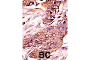 Formalin-fixed and paraffin-embedded human cancer tissue reacted with the primary antibody, which was peroxidase-conjugated to the secondary antibody, followed by AEC staining.