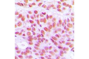 Immunohistochemical analysis of Histone H4 (AcK12) staining in human breast cancer formalin fixed paraffin embedded tissue section. (Histone H4 anticorps  (acLys12, N-Term))
