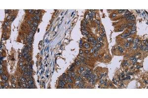 Immunohistochemistry of paraffin-embedded Human colon cancer tissue using CLDND1 Polyclonal Antibody at dilution 1:40 (CLDND1 anticorps)