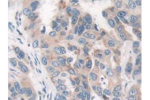 Detection of PAR4 in Human Breast cancer Tissue using Polyclonal Antibody to Protease Activated Receptor 4 (PAR4)