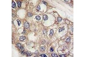 IHC analysis of FFPE human hepatocarcinoma tissue stained with AFP antibody (alpha Fetoprotein anticorps  (AA 300-329))