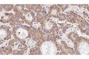 ABIN6279253 at 1/100 staining Human liver cancer tissue by IHC-P. (CPD anticorps  (N-Term))