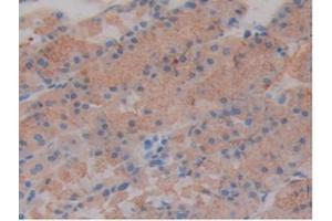 IHC-P analysis of Mouse Stomach Cancer Tissue, with DAB staining. (SLIT1 anticorps  (AA 603-773))
