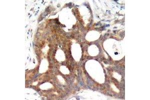 Immunohistochemical analysis of Estrogen Receptor alpha (pS104) staining in human breast cancer formalin fixed paraffin embedded tissue section.