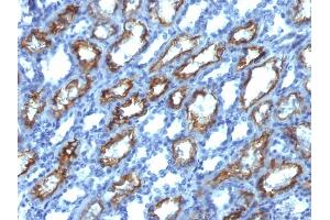 Formalin-fixed, paraffin-embedded human Renal Cell Carcinoma stained with Interferon gamma Mouse Monoclonal Antibody (IFNG/466). (Interferon gamma anticorps)