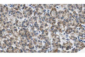ABIN6269004 at 1/100 staining Human liver cancer tissue by IHC-P. (Metabotropic Glutamate Receptor 3 anticorps  (C-Term))