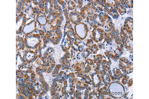 Immunohistochemistry of Human lung cancer using INTS10 Polyclonal Antibody at dilution of 1:50 (INTS10 anticorps)