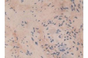 Detection of COL6a3 in Human Stomach cancer Tissue using Polyclonal Antibody to Collagen Type VI Alpha 3 (COL6a3)