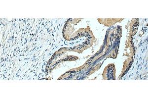 Immunohistochemistry of paraffin-embedded Human prost ate cancer tissue using FCRLA Polyclonal Antibody at dilution of 1:90(x200) (FCRLA anticorps)