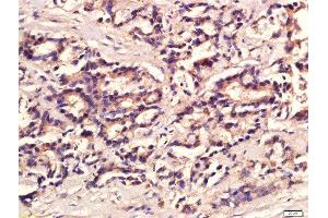 paraformaldehyde-fixed, paraffin embedded human colon carcinoma tissue, Antigen retrieval by boiling in sodium citrate buffer(pH6) for 15min, Block endogenous peroxidase by 3% hydrogen peroxide for 30 minutes, Blocking buffer (normal goat serum) at 37°C for 20min, Antibody incubation with Rabbit Anti-IL12 Polyclonal Antibody, Unconjugated  at 1:500 overnight at 4°C, followed by a conjugated secondary and DAB staining