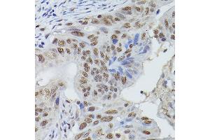 Immunohistochemistry of paraffin-embedded human colon carcinoma using MRE11 Rabbit pAb (ABIN3016249, ABIN3016250, ABIN3016251 and ABIN6219660) at dilution of 1:50 (40x lens).
