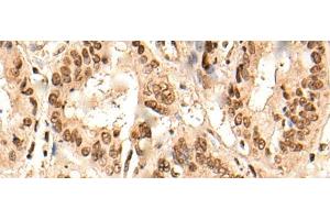Immunohistochemistry of paraffin-embedded Human liver cancer tissue using URI1 Polyclonal Antibody at dilution of 1:45(x200) (URI1 anticorps)