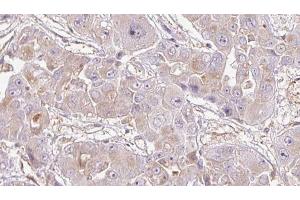 ABIN6272716 at 1/100 staining Human liver cancer tissue by IHC-P. (OR1K1 anticorps)