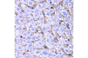 Immunohistochemistry of paraffin-embedded human liver injury using HLA-A antibody at dilution of 1:100 (400x lens).