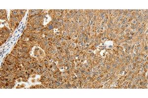 Immunohistochemistry of paraffin-embedded Human ovarian cancer tissue using TFF2 Polyclonal Antibody at dilution 1:40 (Trefoil Factor 2 anticorps)