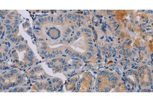 Immunohistochemistry of paraffin-embedded Human thyroid cancer tissue using PYY Polyclonal Antibody at dilution 1:30 (Peptide YY anticorps)