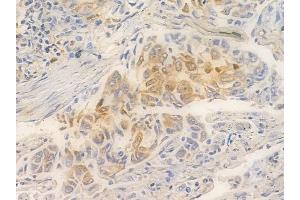 ABIN6261413 and ABIN6266532 at 1/100 staining human lung squamous cell carcinoma by IHC-P. (E2F6 anticorps  (Internal Region))