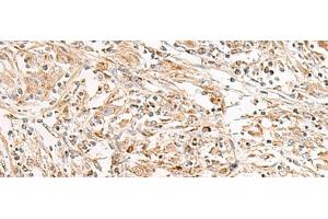 Immunohistochemistry of paraffin-embedded Human liver cancer tissue using FGR Polyclonal Antibody at dilution of 1:35(x200) (Fgr anticorps)