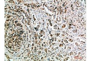 Immunohistochemical analysis of paraffin-embedded human-breast-cancer, antibody was diluted at 1:200 (Nanos Homolog 1 anticorps  (AA 151-200))