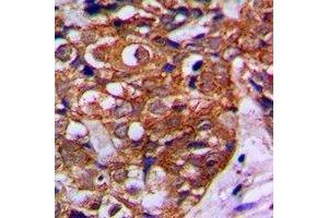 Immunohistochemical analysis of MVK staining in human breast cancer formalin fixed paraffin embedded tissue section. (MVK anticorps)