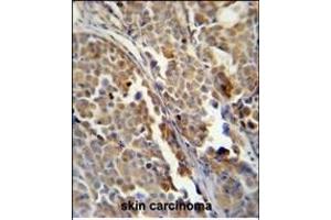 ALDH3A2 Monoclonal Antibody (Ascites) ABIN659009 immunohistochemistry analysis in formalin fixed and paraffin embedded human skin carcinoma followed by peroxidase conjμgation of the secondary antibody and DAB staining. (ALDH3A2 anticorps)