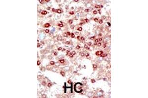 Formalin-fixed and paraffin-embedded human cancer tissue reacted with the primary antibody, which was peroxidase-conjugated to the secondary antibody, followed by DAB staining. (SUMO2/3 anticorps  (C-Term))