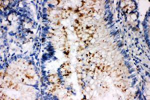 Anti-SSX2 antibody, IHC(P) IHC(P): Human Intestinal Cancer Tissue (SSX2 anticorps  (C-Term))