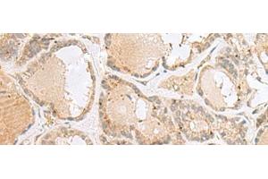 Immunohistochemistry of paraffin-embedded Human thyroid cancer tissue using CNPY3 Polyclonal Antibody at dilution of 1:55(x200)