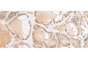 Immunohistochemistry of paraffin-embedded Human thyroid cancer tissue using CNPY3 Polyclonal Antibody at dilution of 1:55(x200) (TNRC5 anticorps)