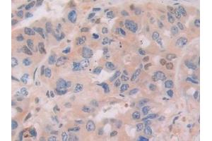 Detection of IFI16 in Human Breast cancer Tissue using Polyclonal Antibody to Interferon Gamma Inducible Protein 16 (IFI16)