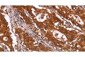 Immunohistochemistry of paraffin-embedded Human gastric cancer using ABI1 Polyclonal Antibody at dilution of 1:40 (ABI1 anticorps)