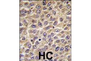 Formalin-fixed and paraffin-embedded human hepatocarcinoma tissue reacted with ILK Antibody (S246) , which was peroxidase-conjugated to the secondary antibody, followed by DAB staining. (ILK anticorps  (AA 225-253))