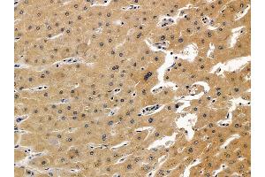 ABIN7093888 and ABIN7097931 at 1/100 staining human liver cancer and adjacent non-tumor tissue by IHC-P.