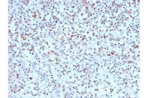 Formalin-fixed, paraffin-embedded human Hodgkin's Lymphoma stained with BCL-6 Mouse Monoclonal Antibody (BCL6/1527).