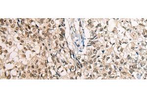 Immunohistochemistry of paraffin-embedded Human lung cancer tissue using CDT1 Polyclonal Antibody at dilution of 1:45(x200)